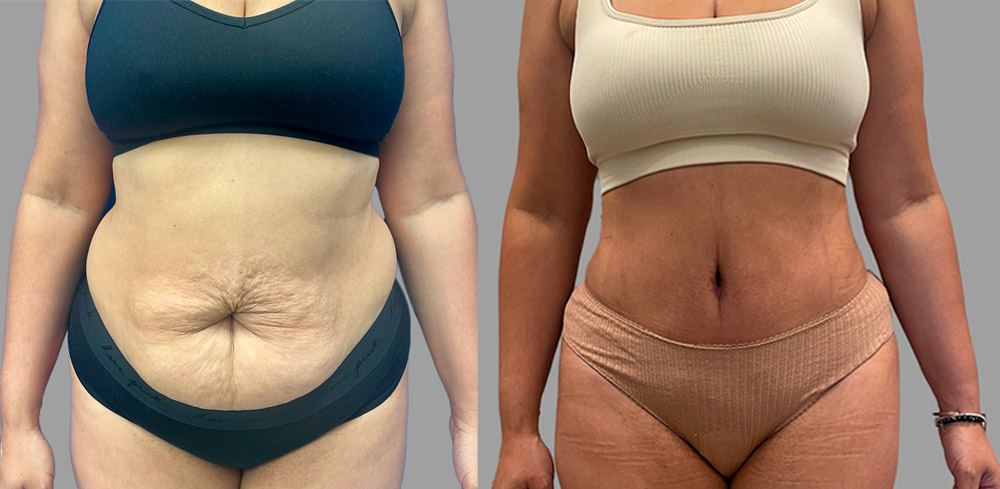 before and after pictures of a tummy tuck patient