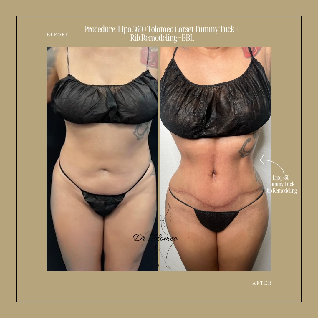Corset Tummy Tuck Before and After: Real Waist Transformation Results - Feature Image
