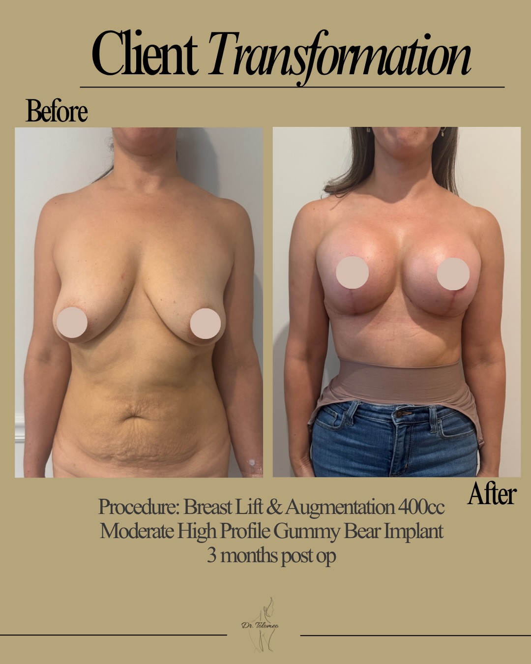 “When will my breasts actually look normal after surgery?”