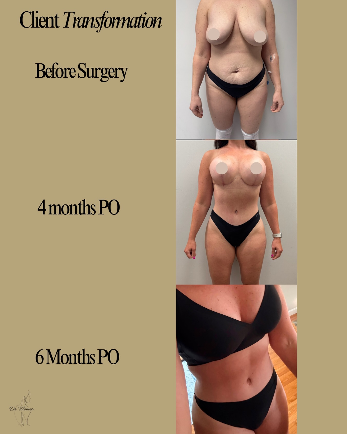 Client Transformation Before Surgery, 4 Month Post Op & 6 Months Post op Procedure: Lipo 360 + Corset Tummy Tuck + Breast Lift and augmentation using a 500 cc Moderate High Profile Gummy Bear Implant. Ready to start your aesthetic journey? Text (516) 350-8168 to schedule your consultation! Financing Available Tampa, Florida Fall River, Massachusetts Tulsa, Oklahoma #lipo#tummytuck#breastlift#breastaugmentation#beforeandafter