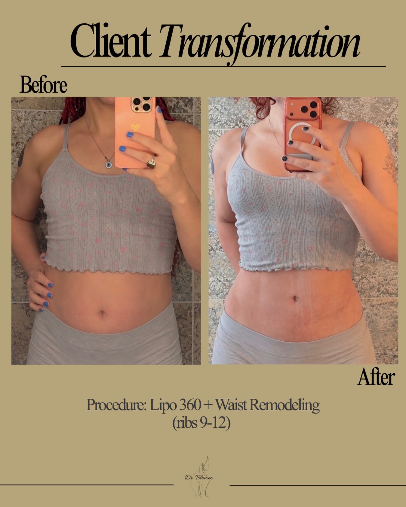 Same outfit. A whole new silhouette Procedure: Lipo 360 + Waist Remodeling - 3 months post op Ready to start your aesthetic journey? Text (516) 350-8168 to schedule your consultation! Financing Available Tampa, Florida Fall River, Massachusetts Tulsa, Oklahoma #lipo#ribremodeling#snatchedwaist#beforeandafter#clienttransformation
