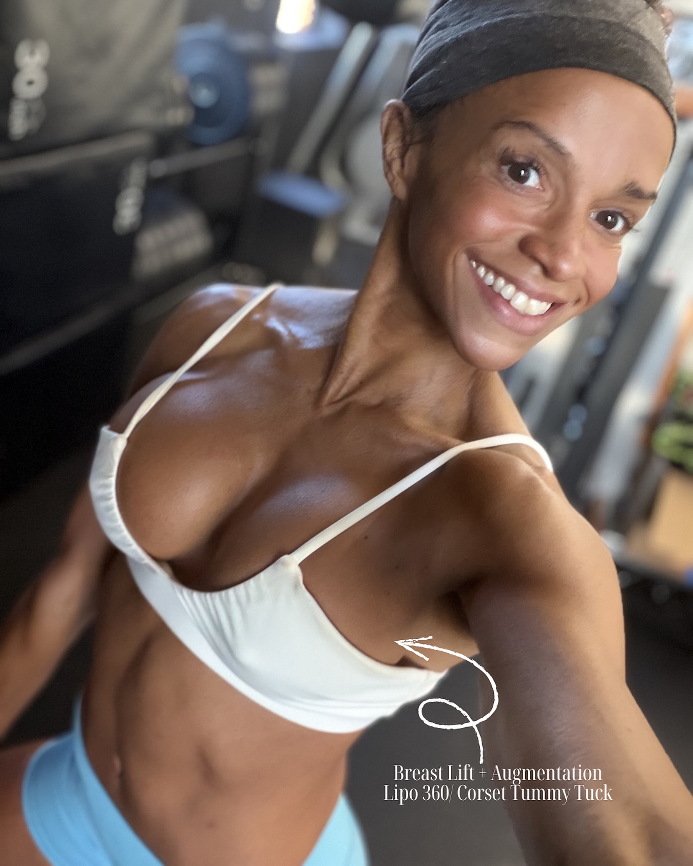 Client Transformation Procedure: Lipo 360 + Corset Tummy Tuck + Breast lift & Augmentation Ready to start your aesthetic journey? Text (516) 350-8168 to schedule your consultation! Financing Available Tampa, Florida Fall River, Massachusetts Tulsa, Oklahoma #breastaugmentation#breastlift#breastimplants#tummytuck #lipo