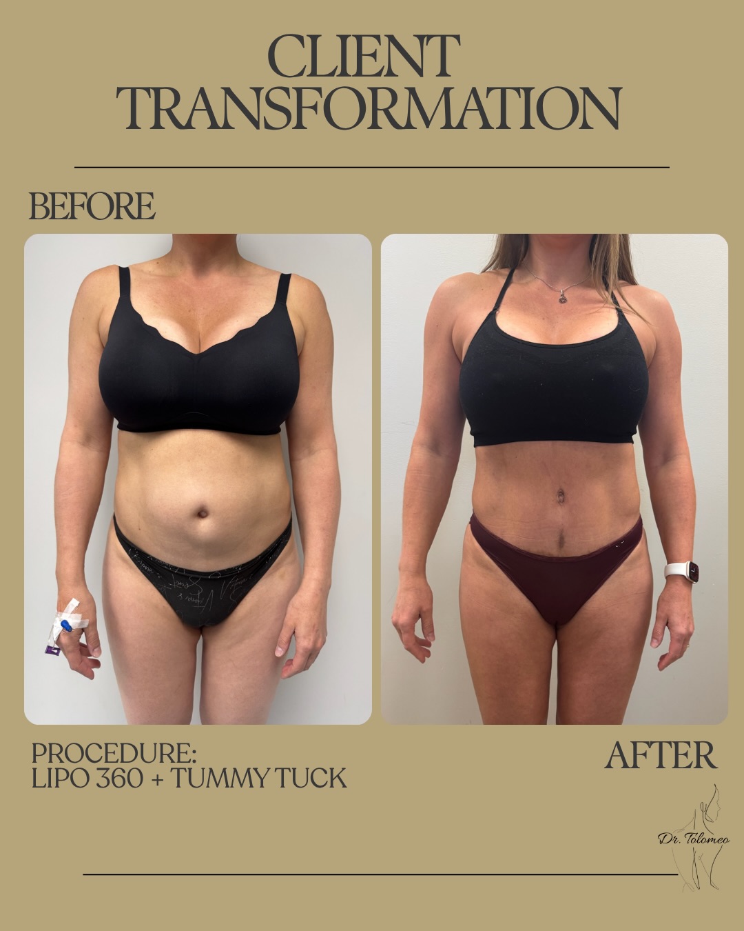 Look at this incredible transformation! This client is 1 year post-op from her Lipo 360 + Tummy Tuck procedure. Ready to start your aesthetic journey? Text (516) 350-8168 to schedule your consultation! Financing Available Tampa, Florida Fall River, Massachusetts Tulsa, Oklahoma #lipo#beforeandafter#tummytuck#cosmeticsurgery#tummytuckbeforeandafter