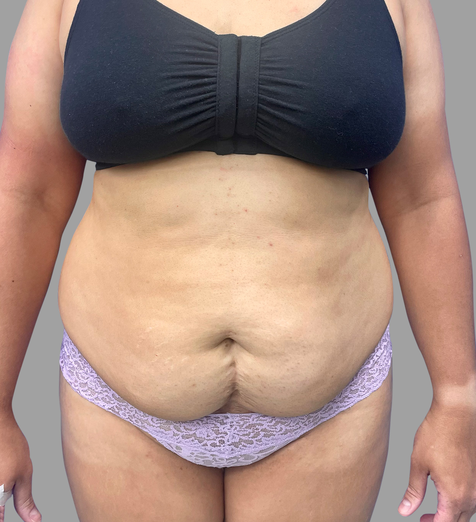 Case--5469 | Before Lipo 360 - Tummy Tuck