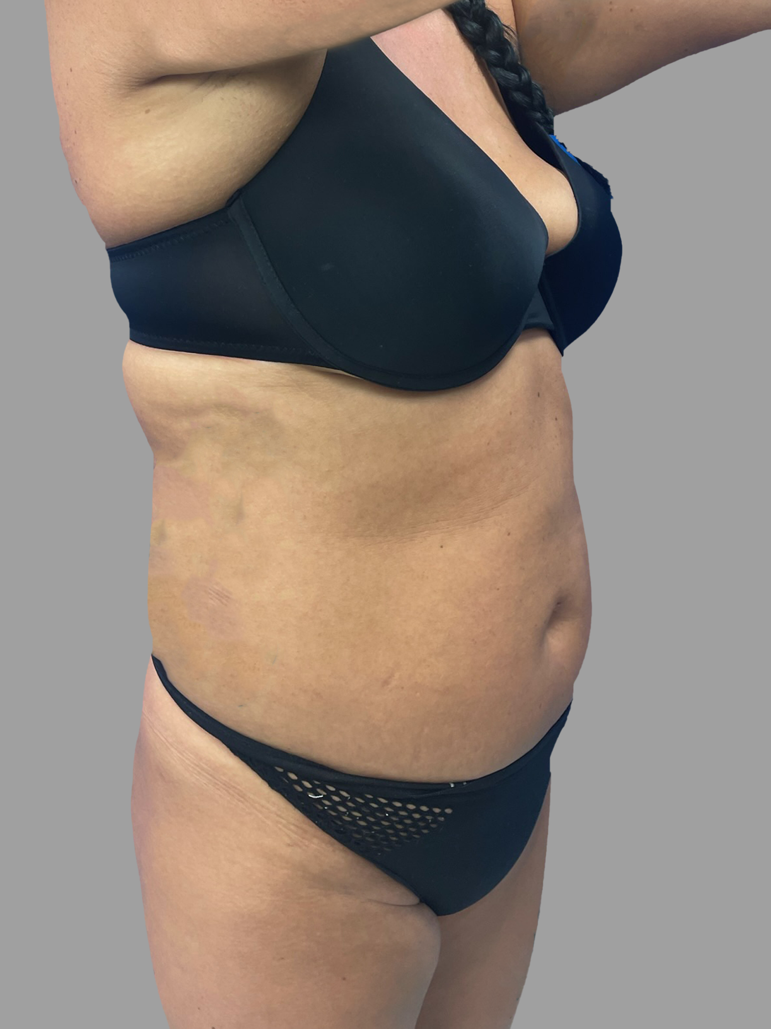 Lipo 360 - Brazilian Butt Lift