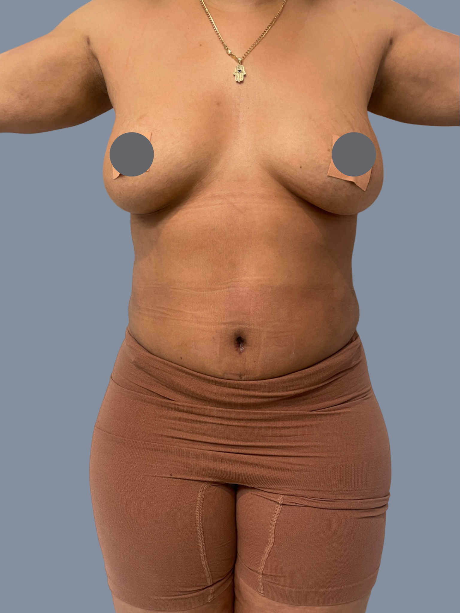 Liposuction 360 - Tummy Tuck