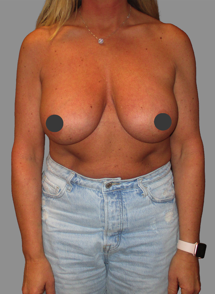 Breast Augmentation with Lift