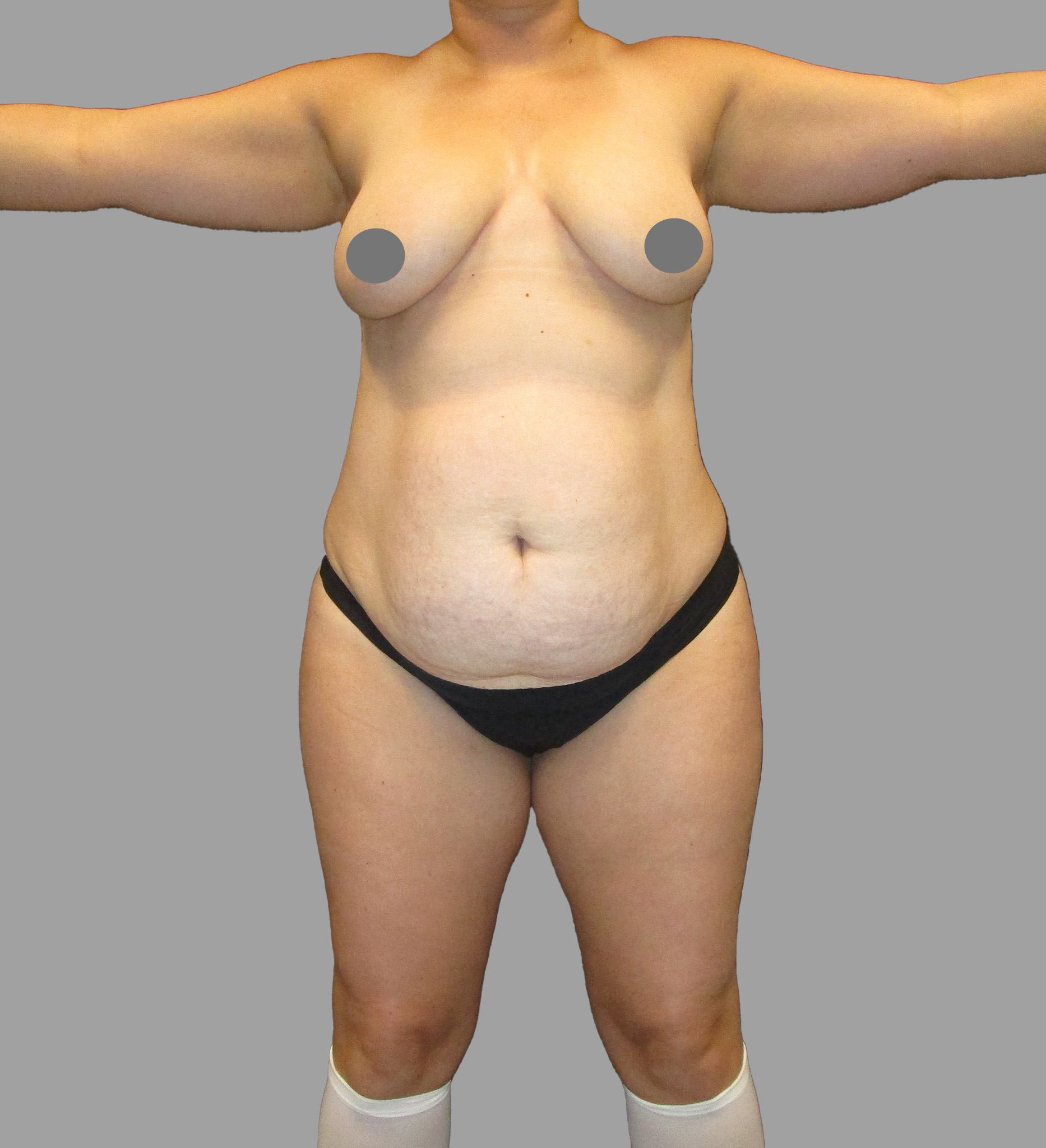 Liposuction 360 - Tummy Tuck