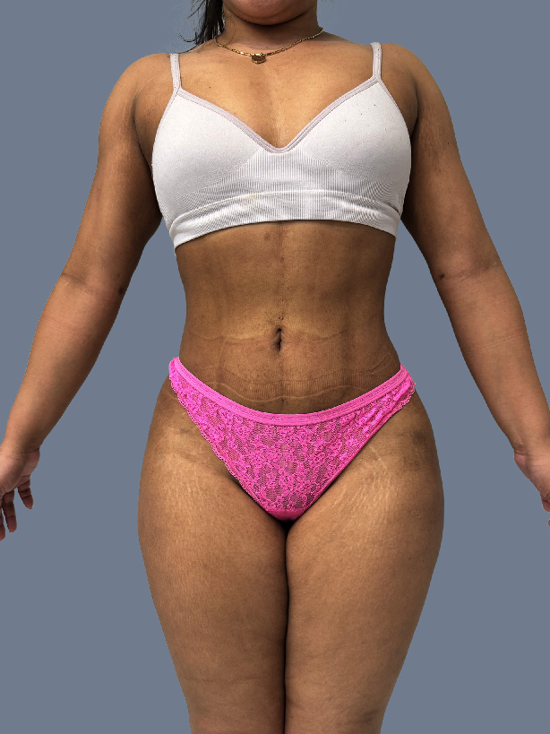 Case--4189-Lipo-360---8211--Brazilian-Butt-Lift-and-Arm-Liposuction | After Lipo 360 - Brazilian Butt Lift