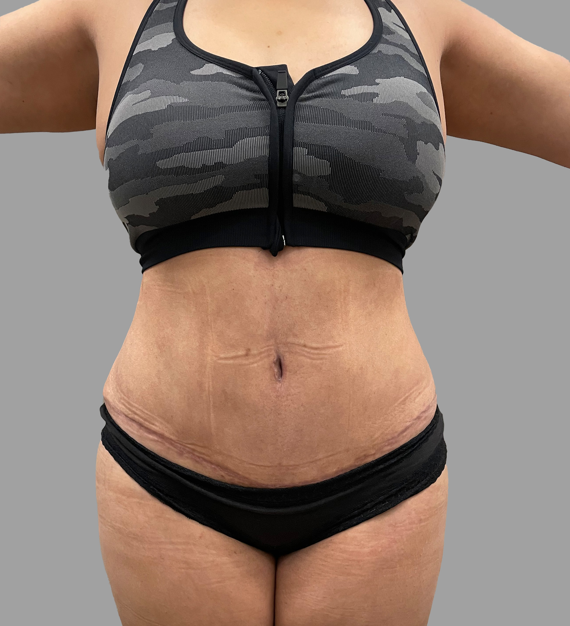 Case--5469 | After Lipo 360 - Tummy Tuck