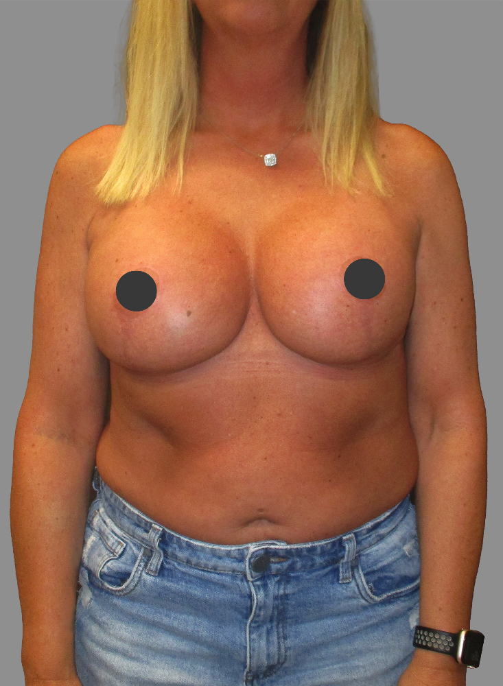 Breast Augmentation with Lift