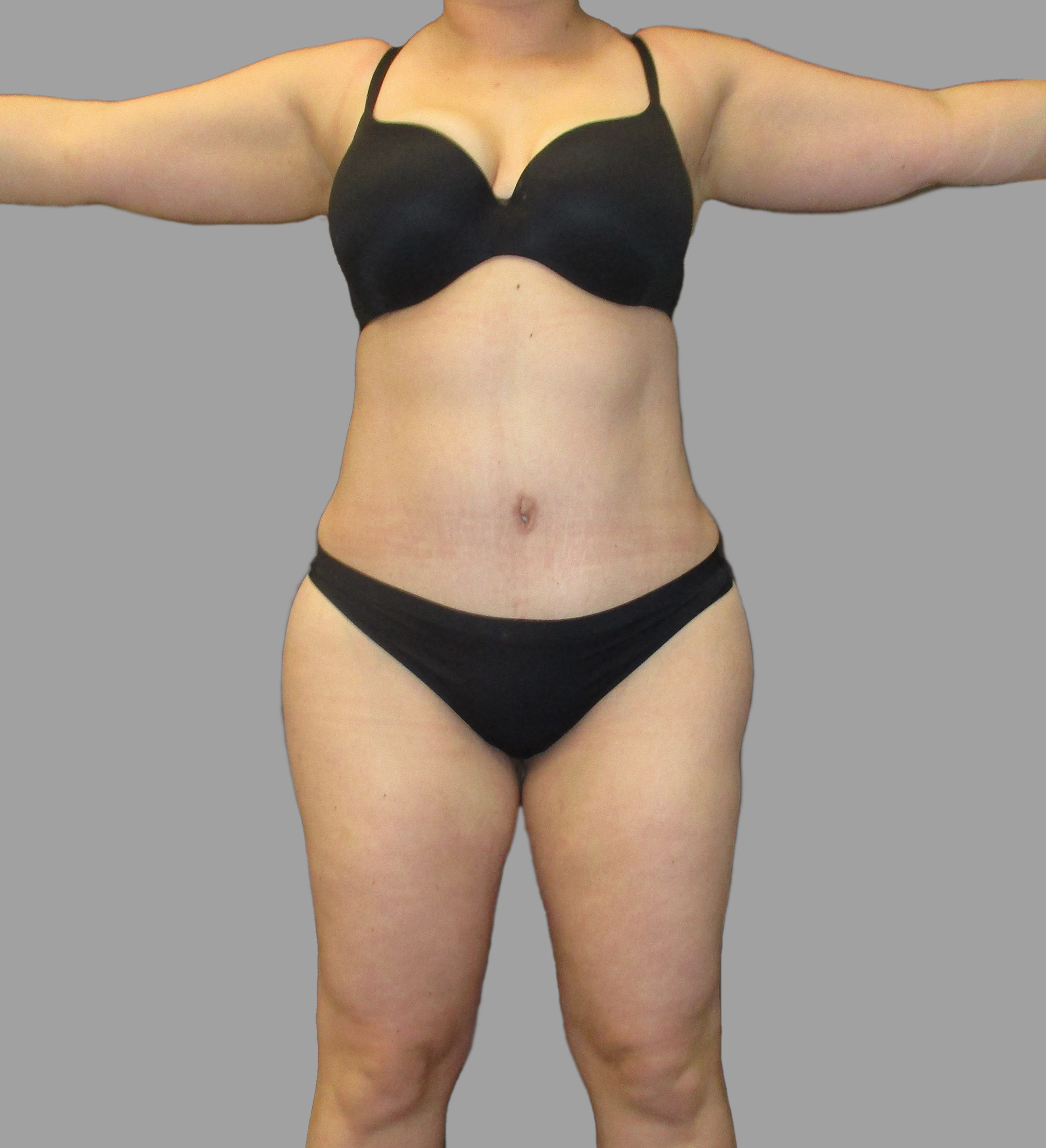 Liposuction 360 - Tummy Tuck