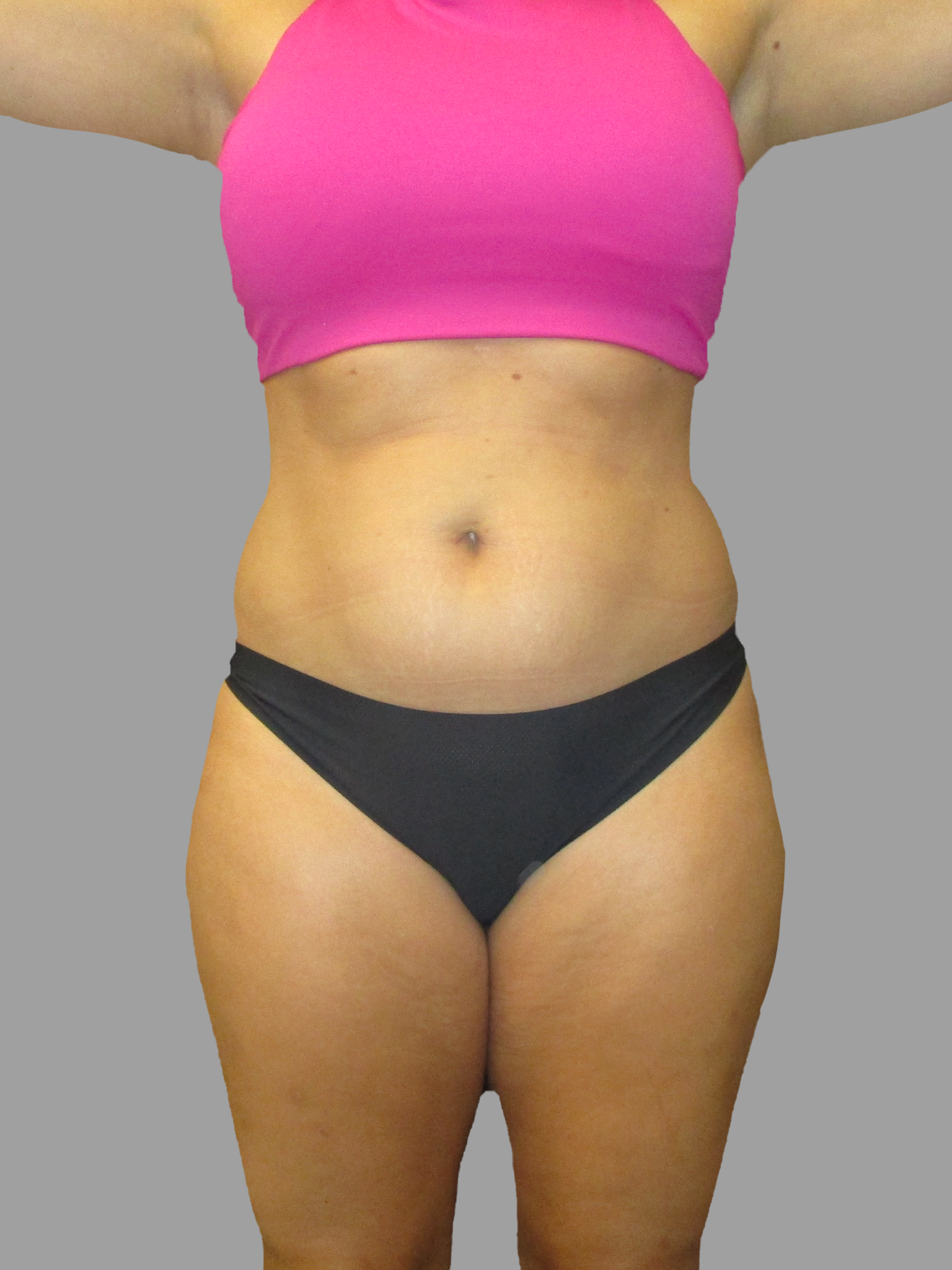 Liposuction 360 - Mini Tummy Tuck