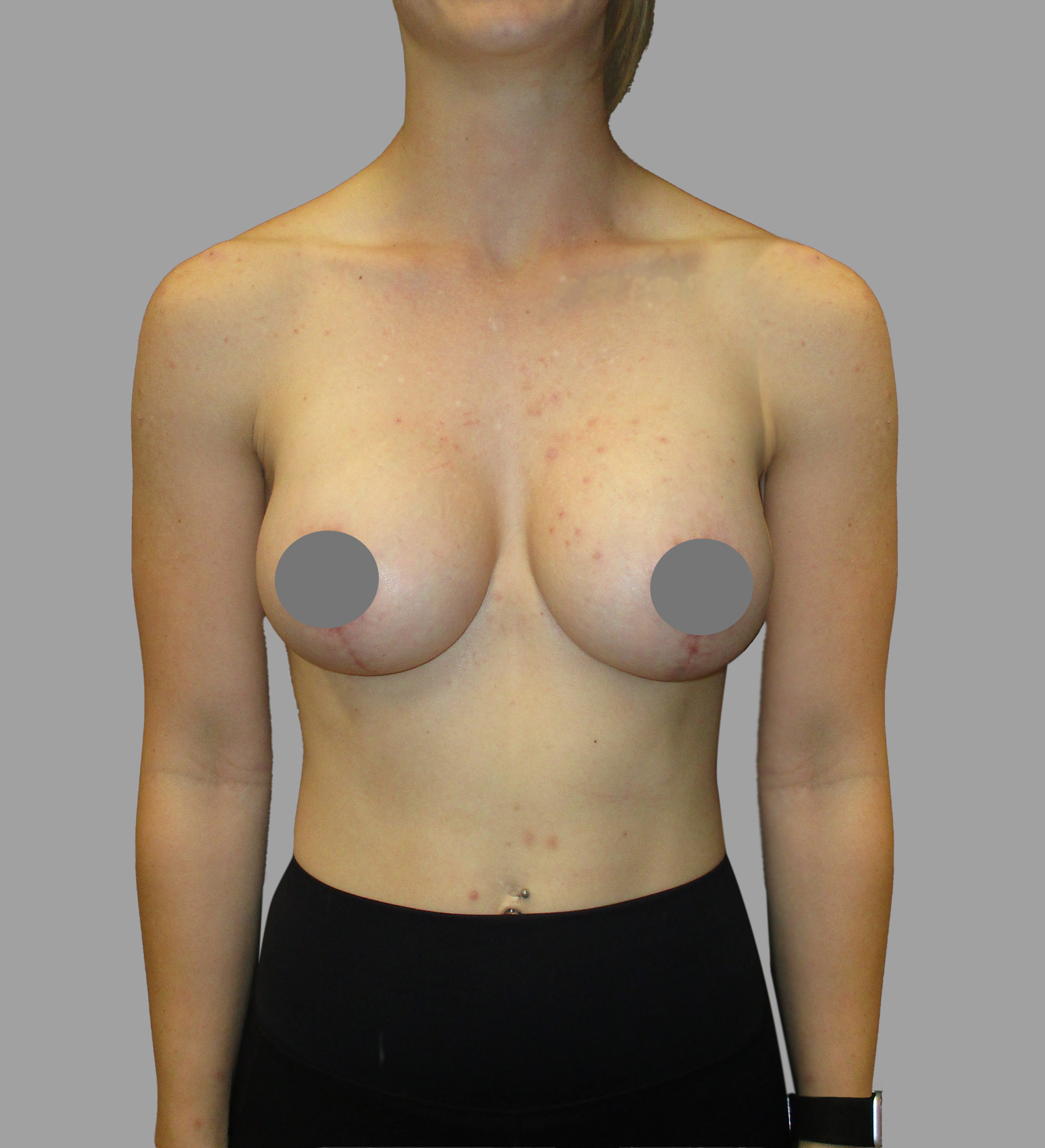 Breast Aug with Lift