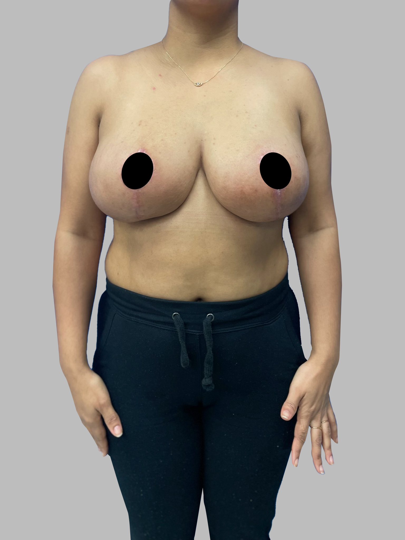 Breast Reduction with Lift