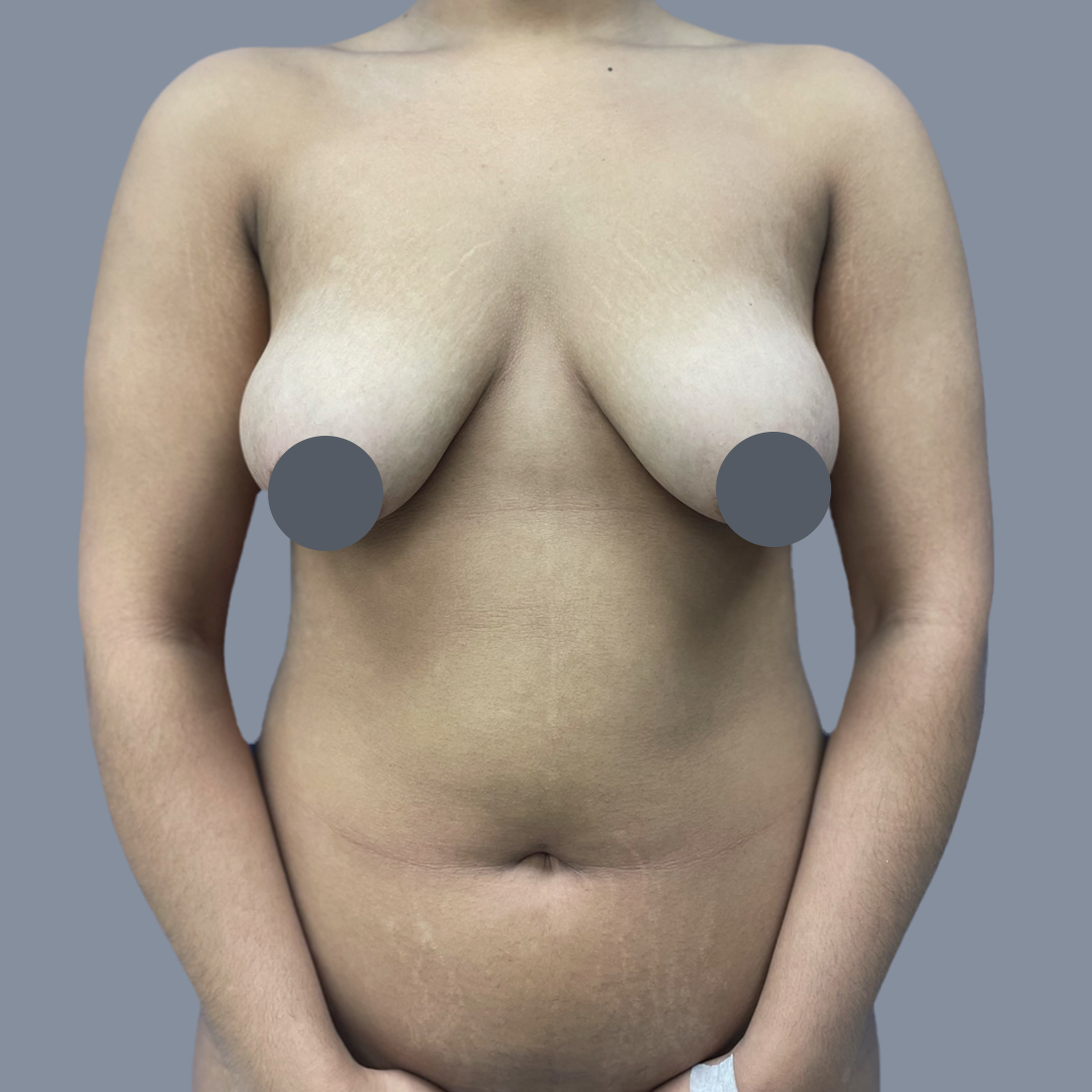 Breast Augmentation with Lift