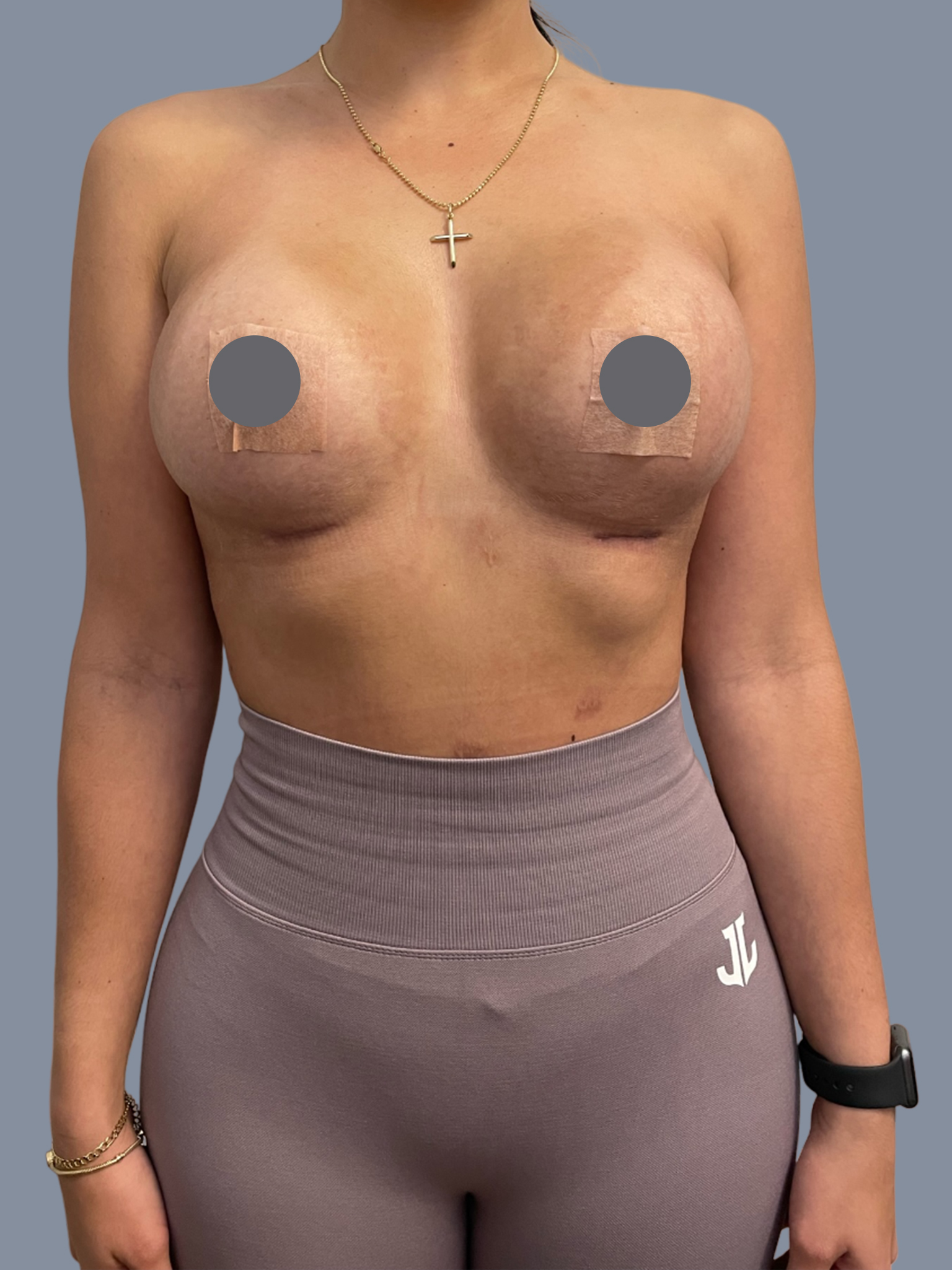 Breast Augmentation 