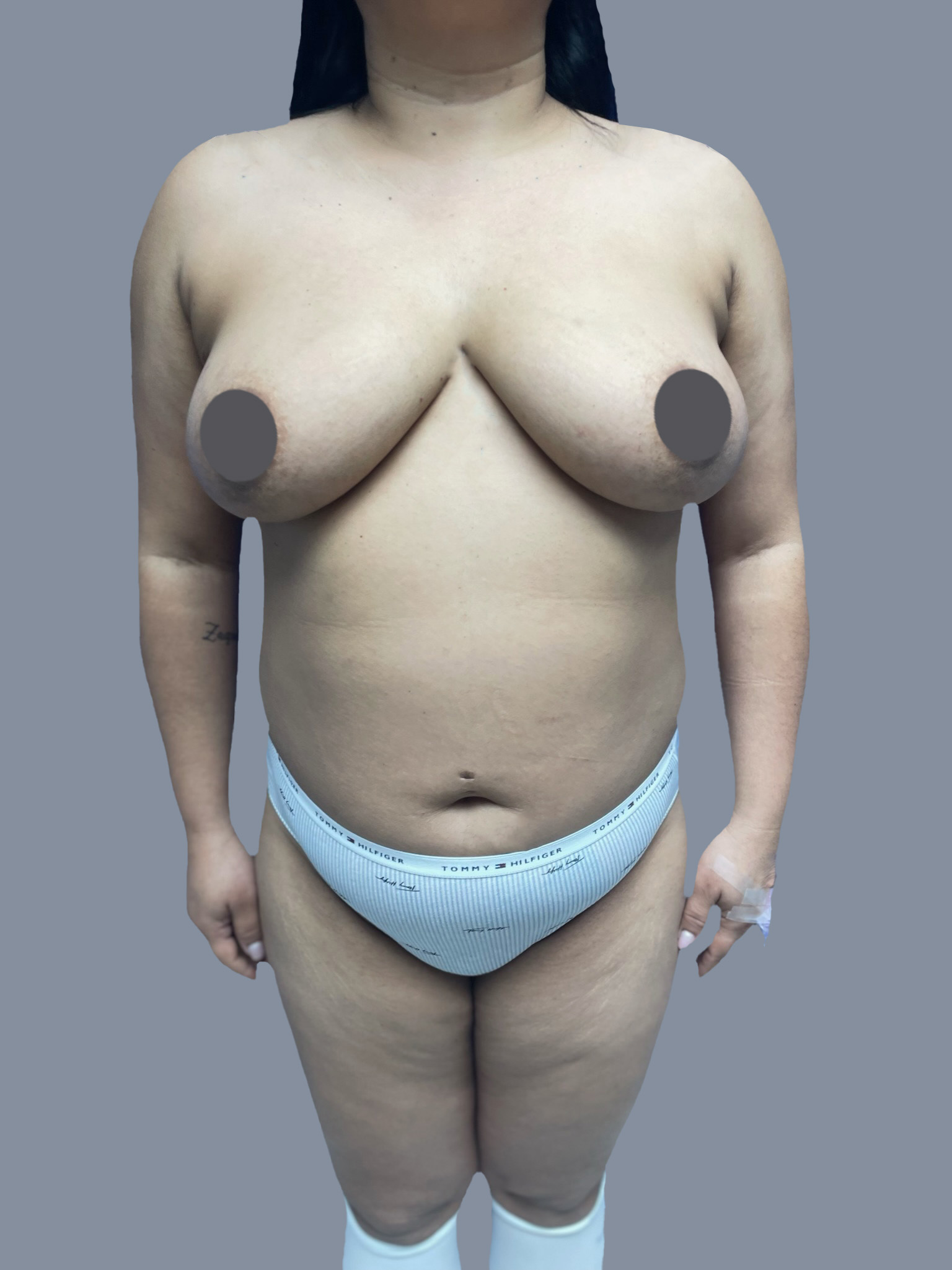 Liposuction 360 & Tummy Tuck