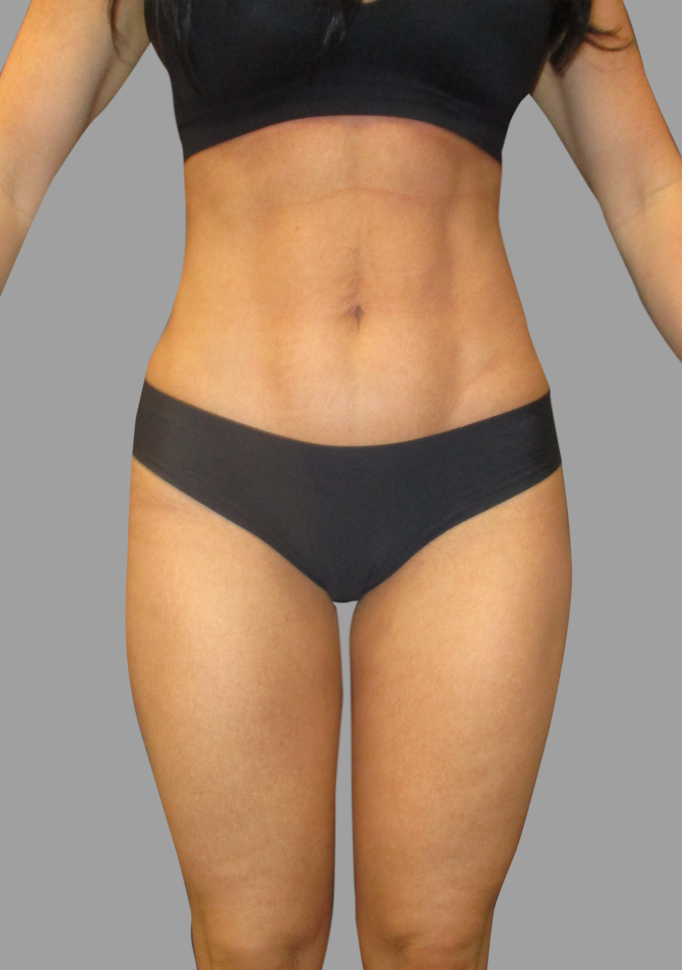 Liposuction 360 - Mini Tummy Tuck
