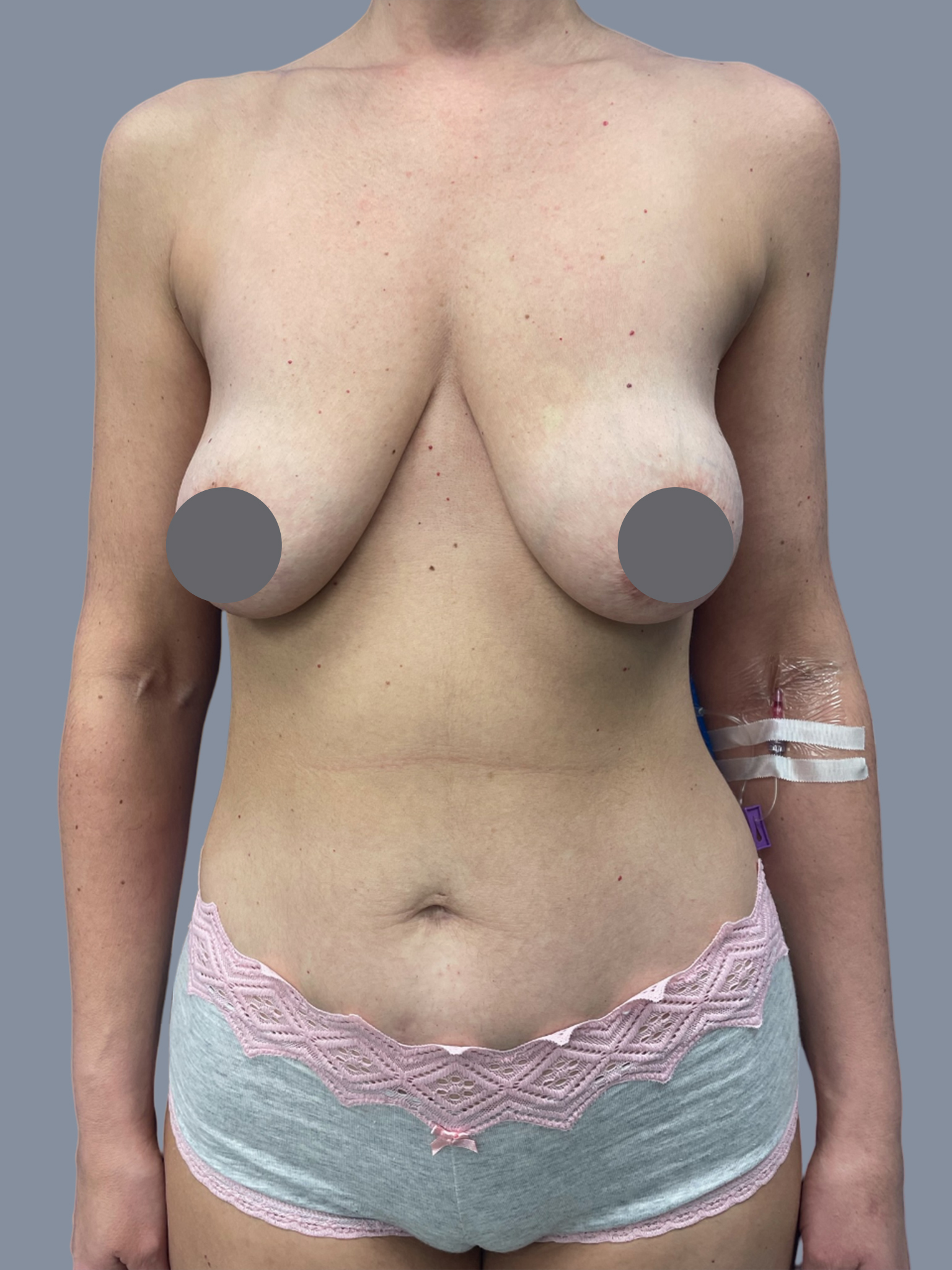 Breast Augmentation with Lift