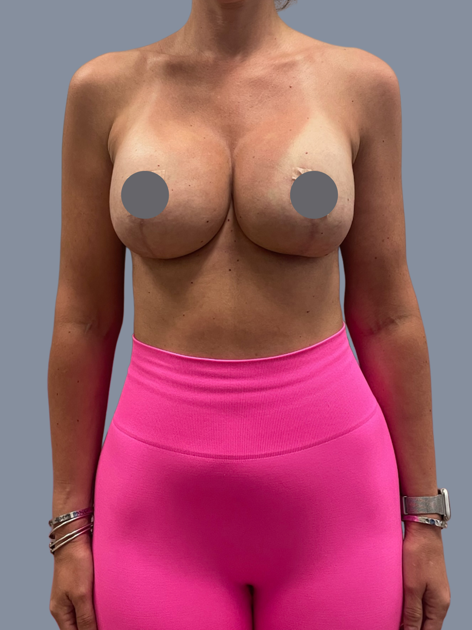 Breast Augmentation with Lift