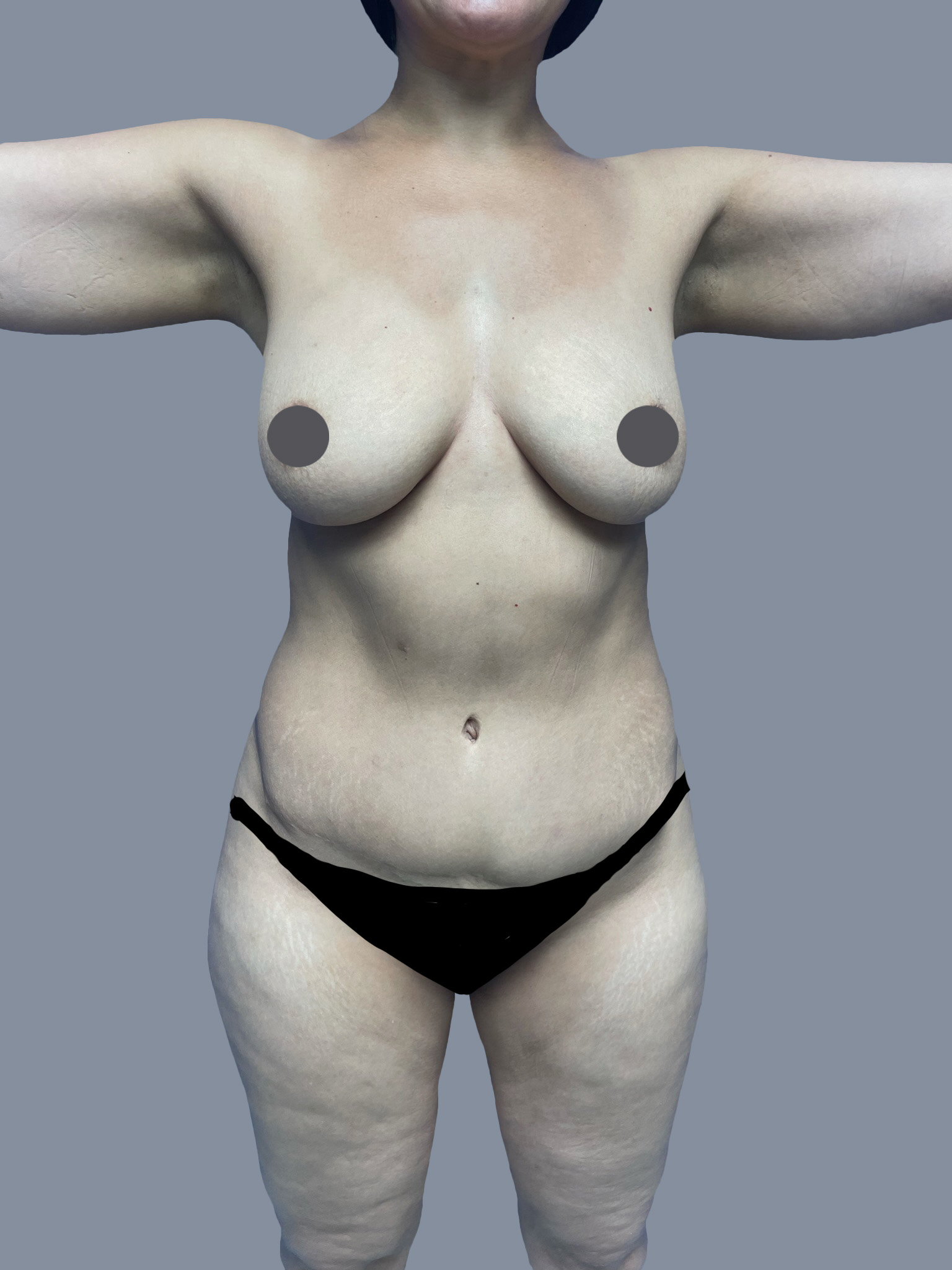 High Def Liposuction - Thighs