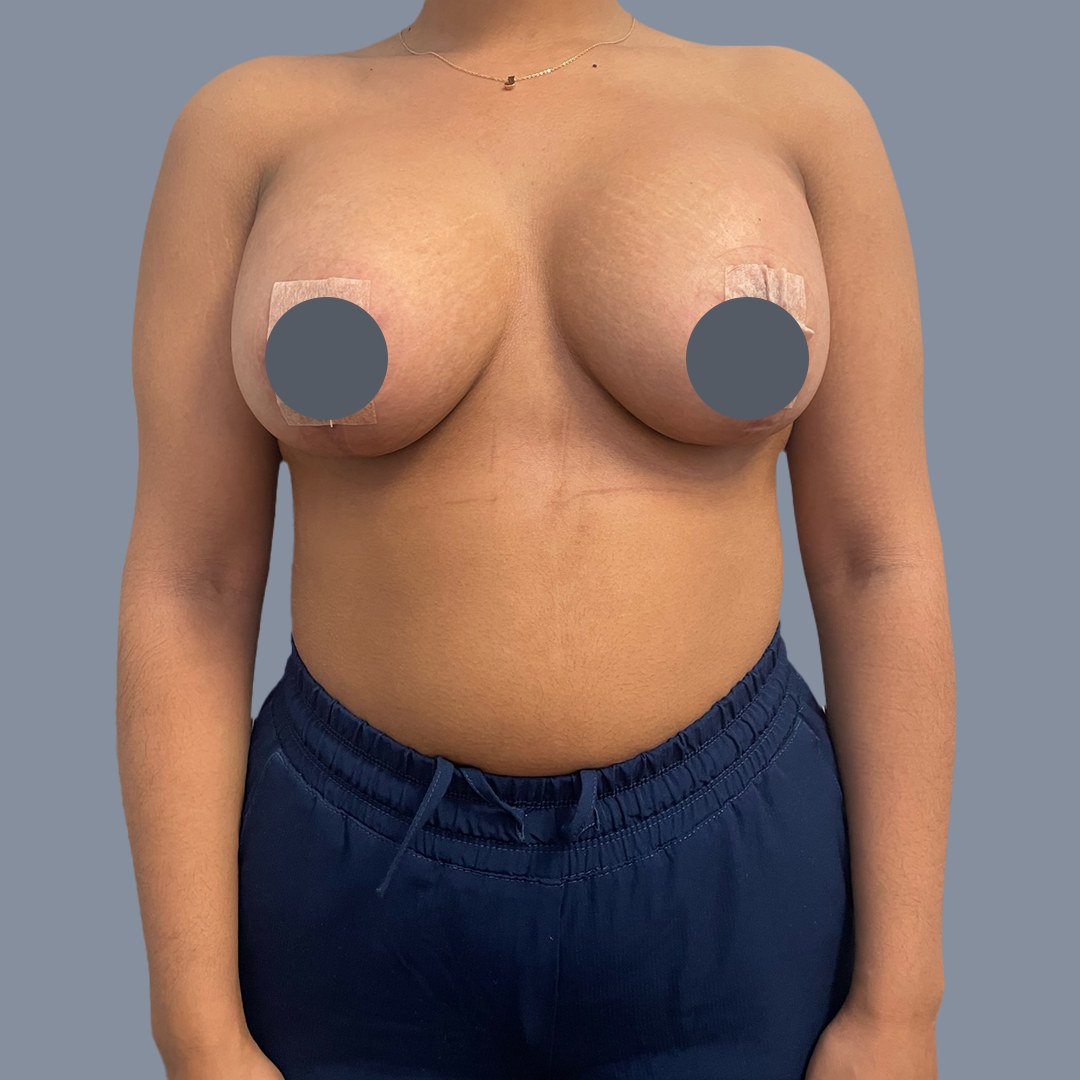 Breast Augmentation with Lift