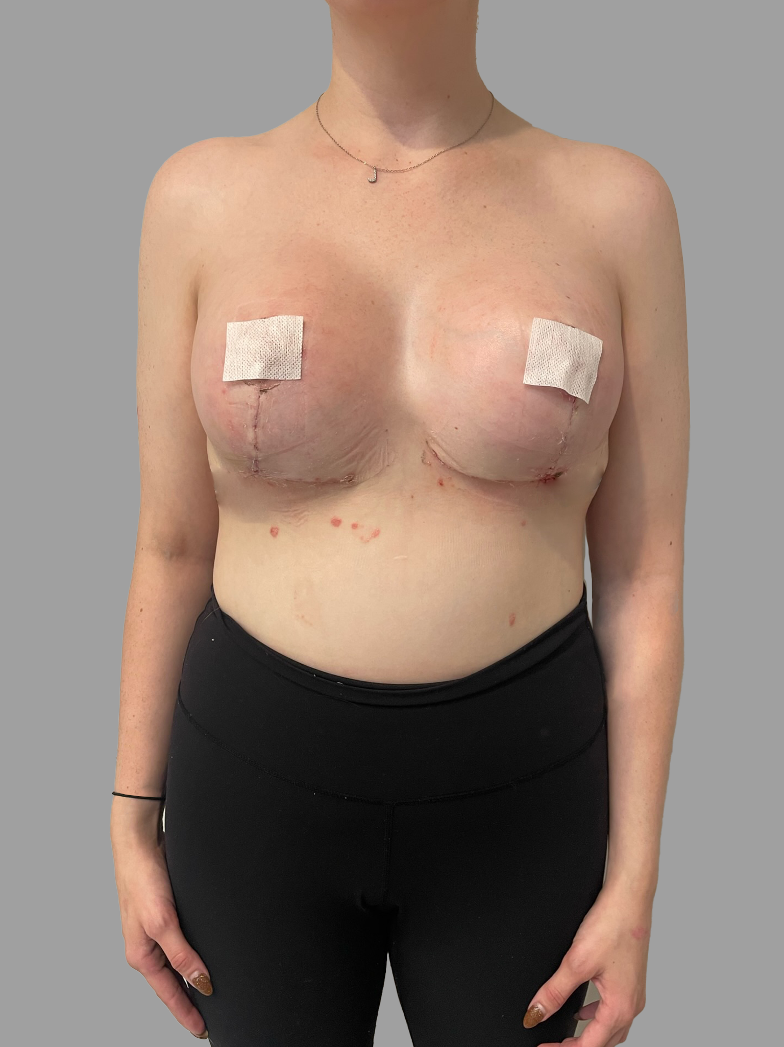 Breast Augmentation with Lift