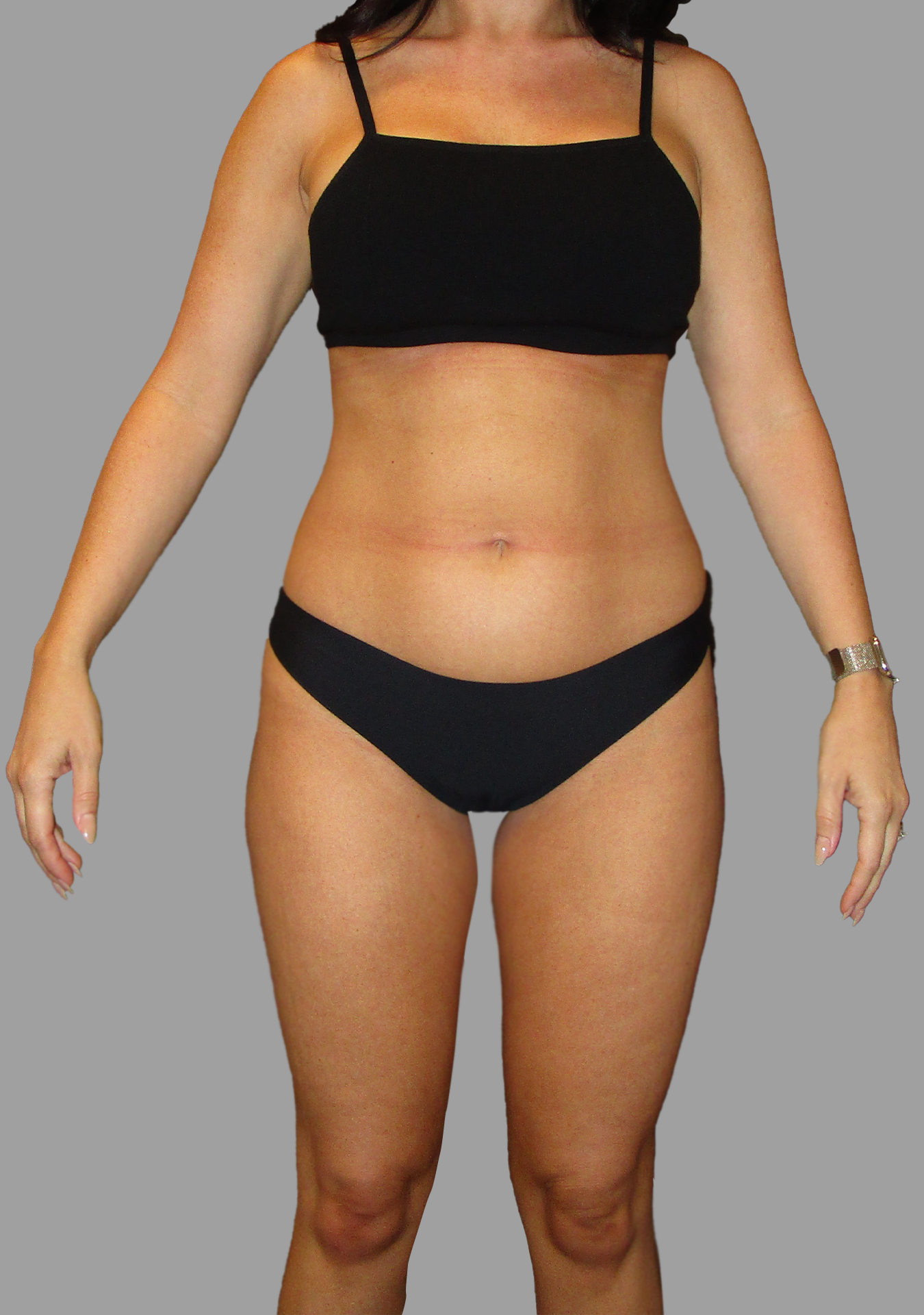 Liposuction 360 - Mini Tummy Tuck
