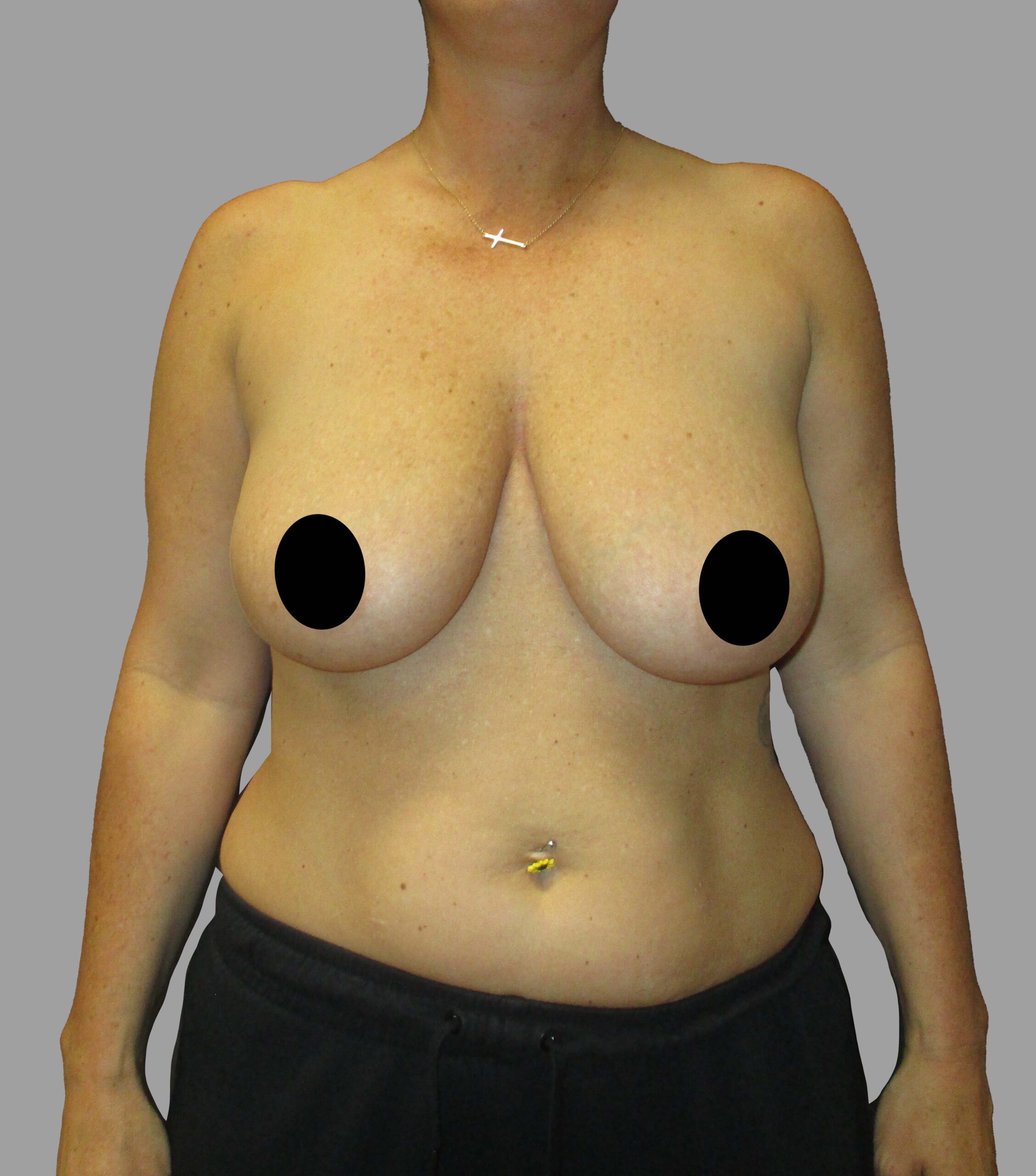 Breast Aug with Lift