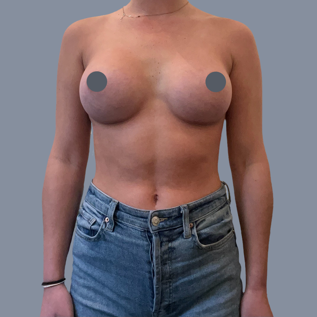 Breast Augmentation