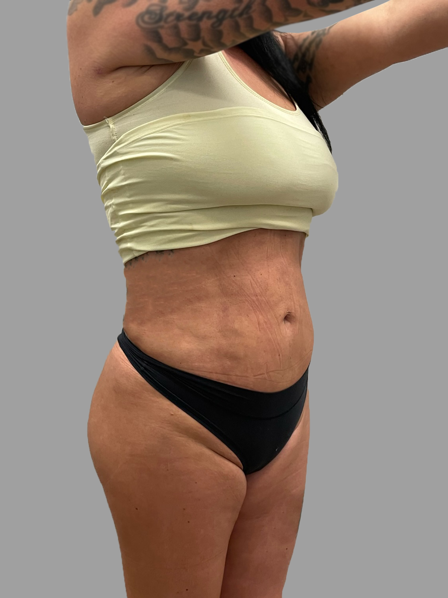 Lipo 360 - Brazilian Butt Lift