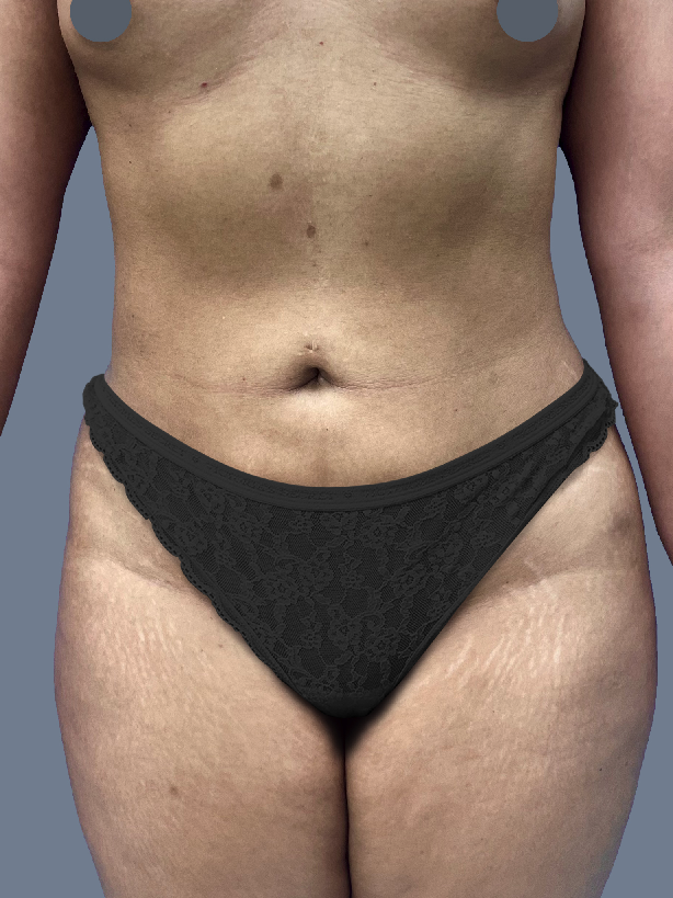 Case--4189-Lipo-360---8211--Brazilian-Butt-Lift-and-Arm-Liposuction | Before Lipo 360 - Brazilian Butt Lift