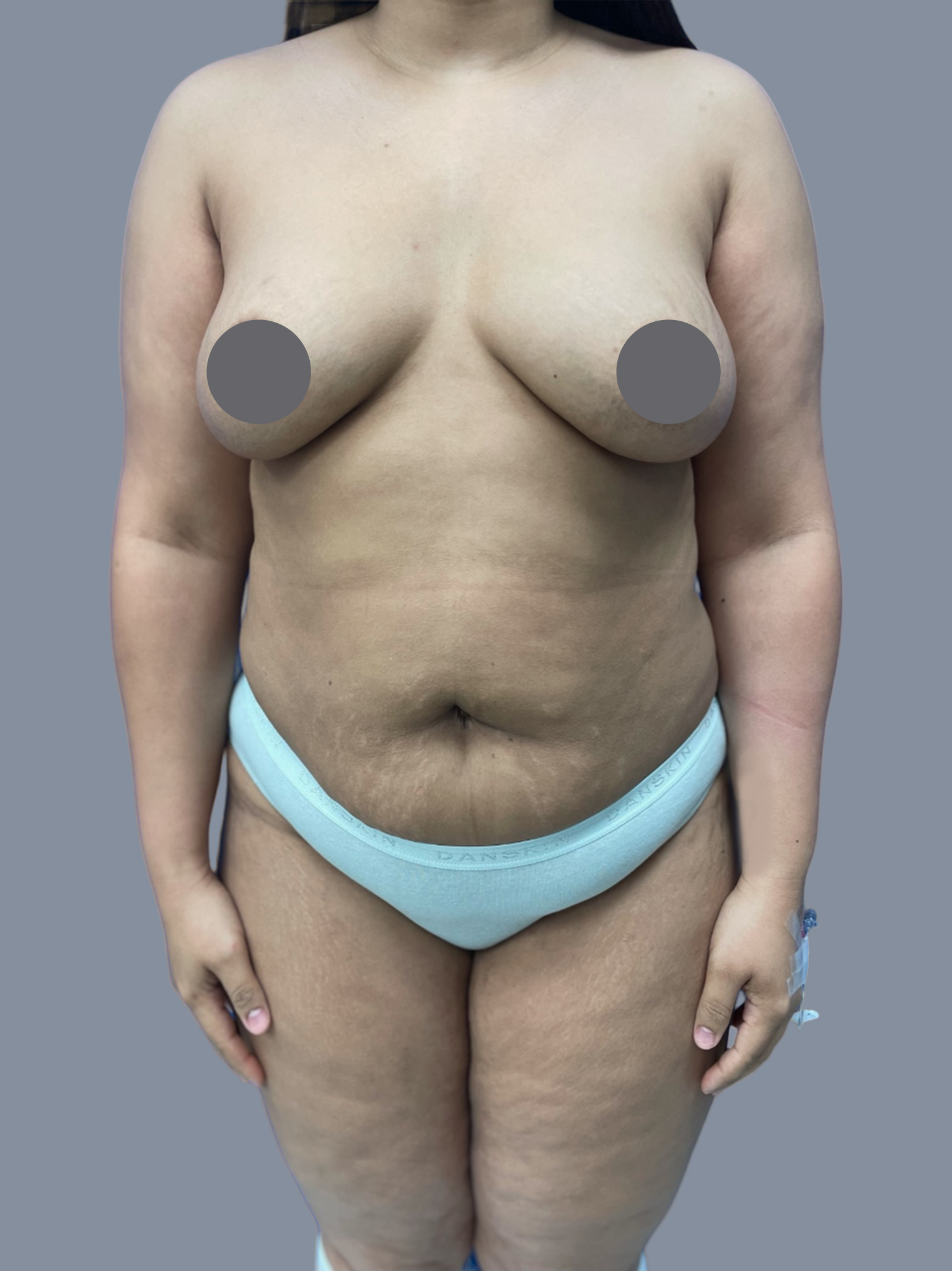 Liposuction 360 - Tummy Tuck