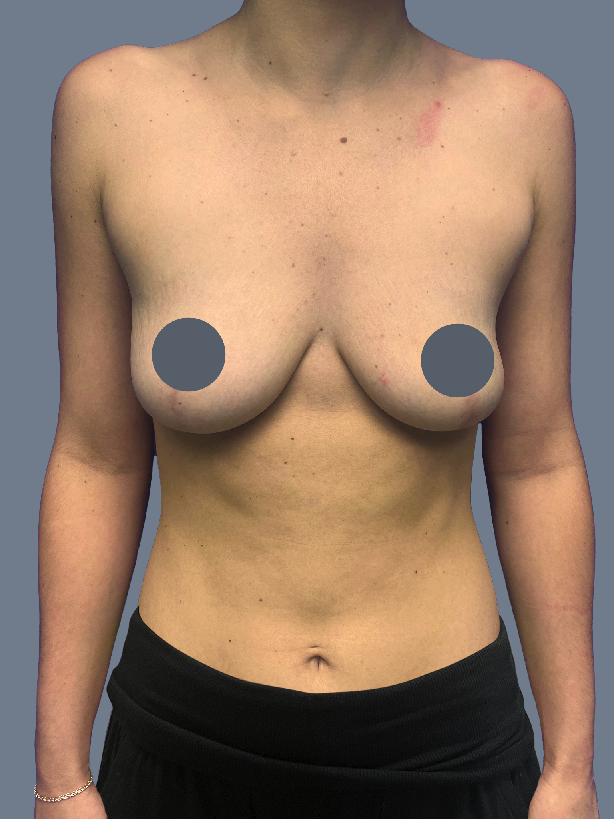 Case--8500-Breast-Augmentation | Before Breast