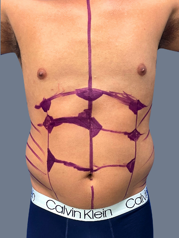 Case--2876-Male-High-Definition-Liposuction | Before Male High Definition Liposuction