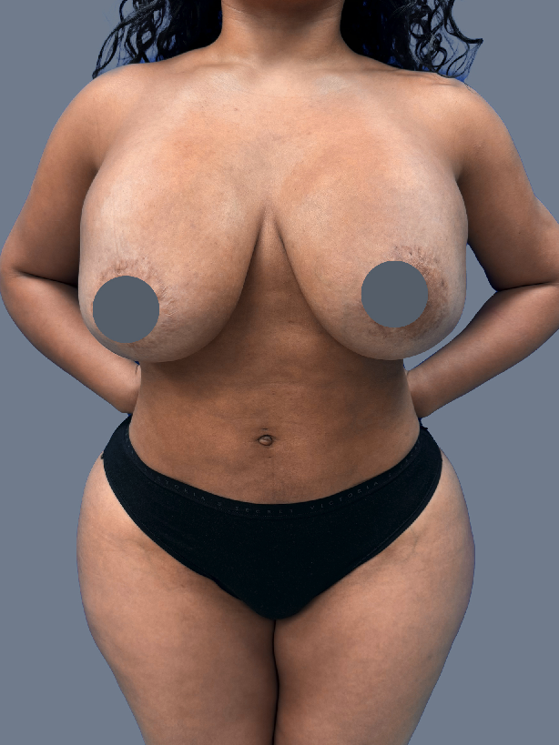 Case--7065-Breast-Revision | Before Breast