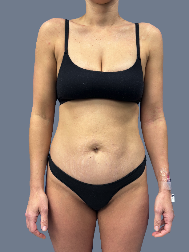 Case--8438-Lipo-360---8211--Tummy-Tuck | Before Lipo 360 - Tummy Tuck