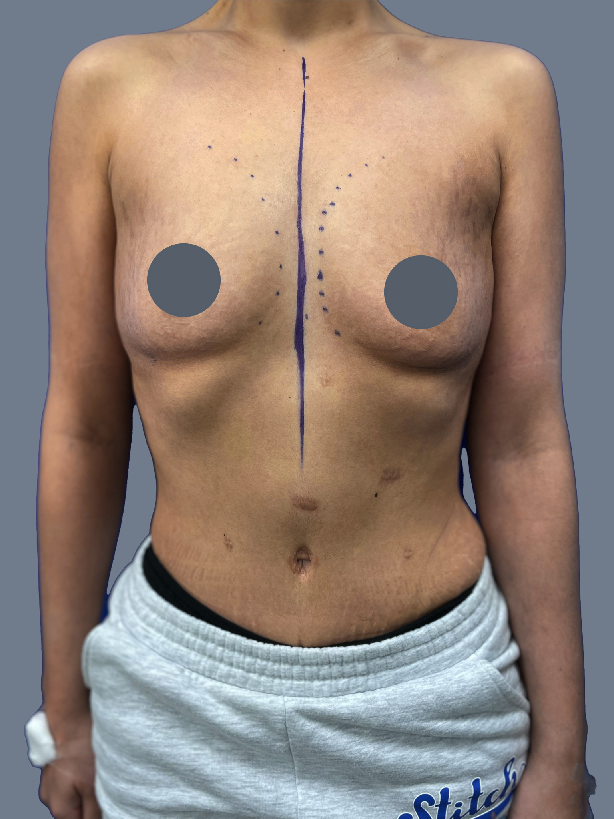 Case--2332-Breast-Augmentation | Before Breast