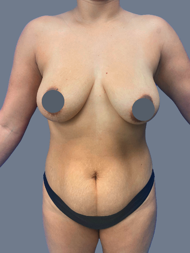 Case--8874-Breast-Augmentation-with-Lift | Before Breast