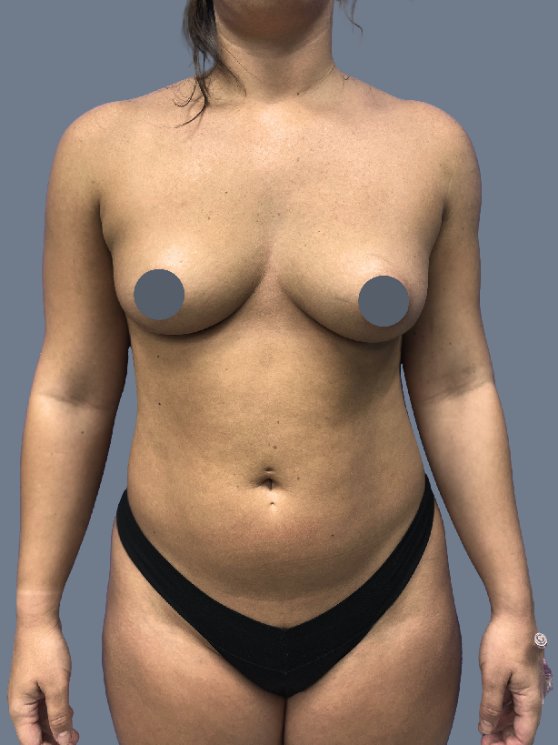 Case--7786-Breast-Augmentation | Before Breast