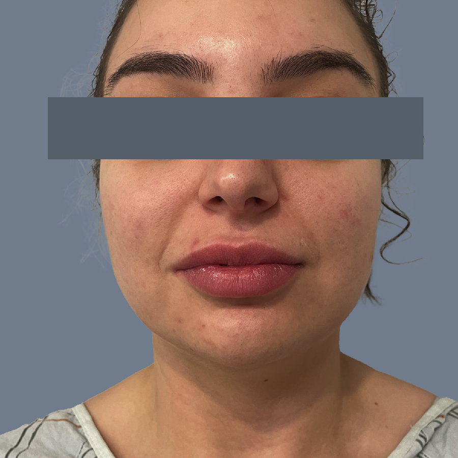 Case--3070-Chin-Liposuction | Before Face