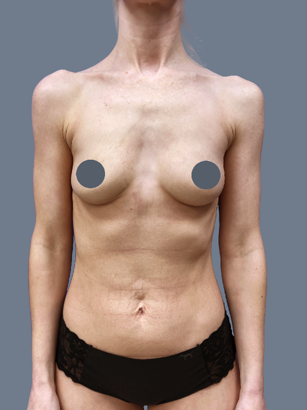 Case--2460-Breast-Augmentation | Before Breast