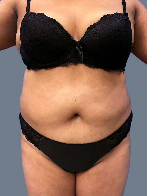 Case--9307-Lipo-360---8211--Brazilian-Butt-Lift | Before Lipo 360 - Brazilian Butt Lift
