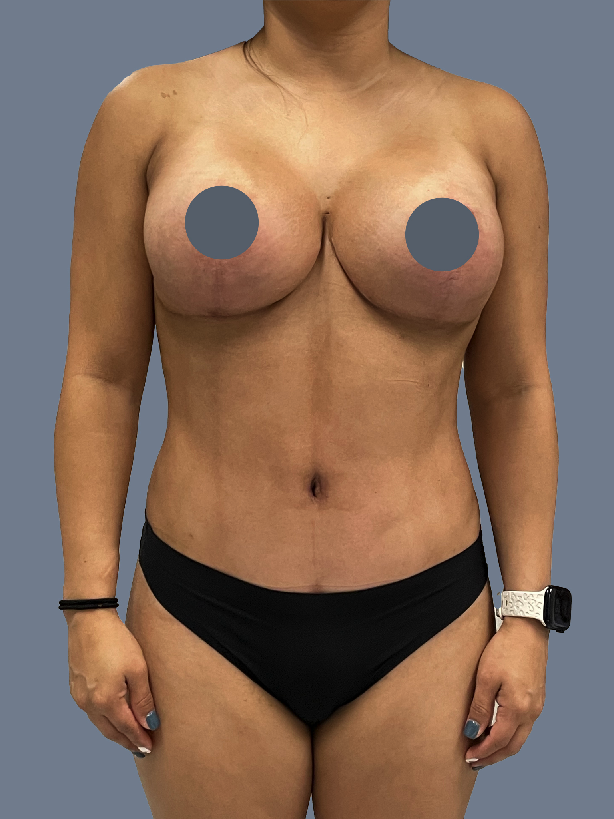 Case--3375-Lipo-360---8211--Tummy-Tuck-and-Breast-Augmentation-with-Lift | After Breast