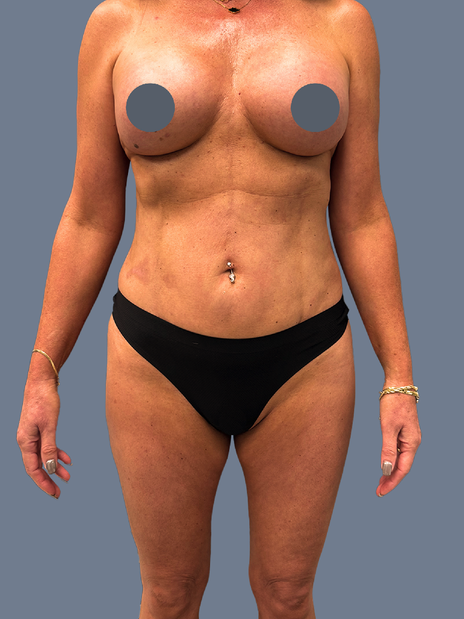 Case--9109-Lipo-360---8211--Breast-Augmentation | After Lipo 360 - Breast Augmentation