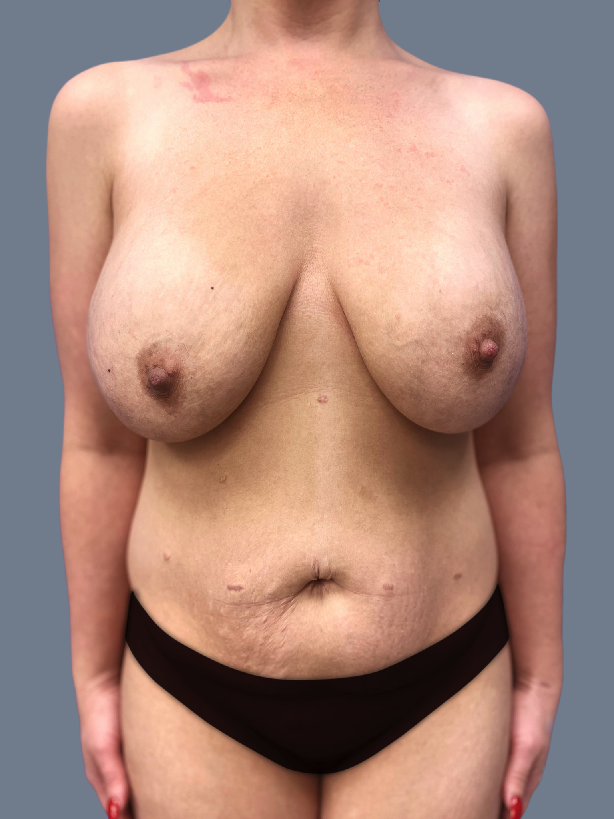 Case--6829-Lipo-360---8211--Brazilian-Butt-Lift-and-Arm-Liposuction | Before Lipo 360 - Brazilian Butt Lift