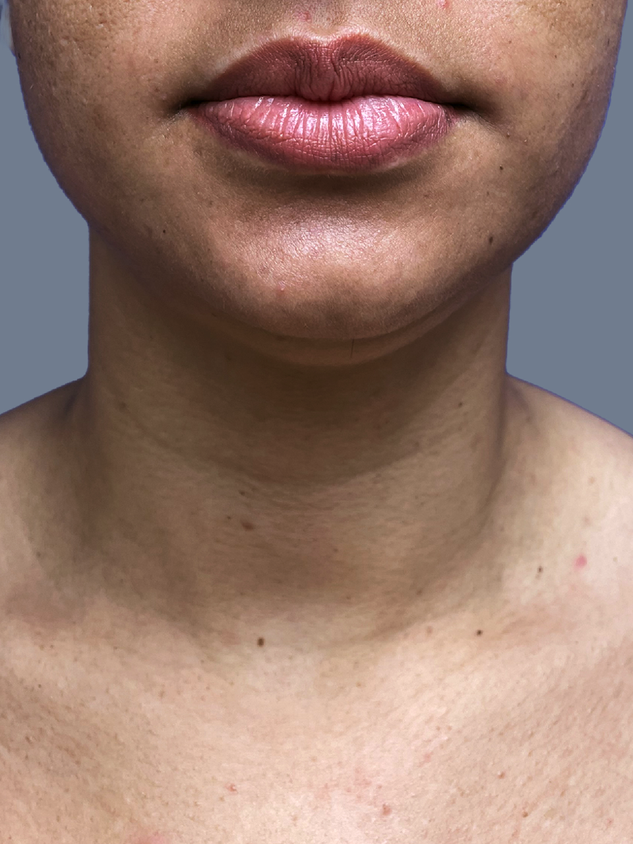 Case--7832-Chin-Liposuction | Before Face