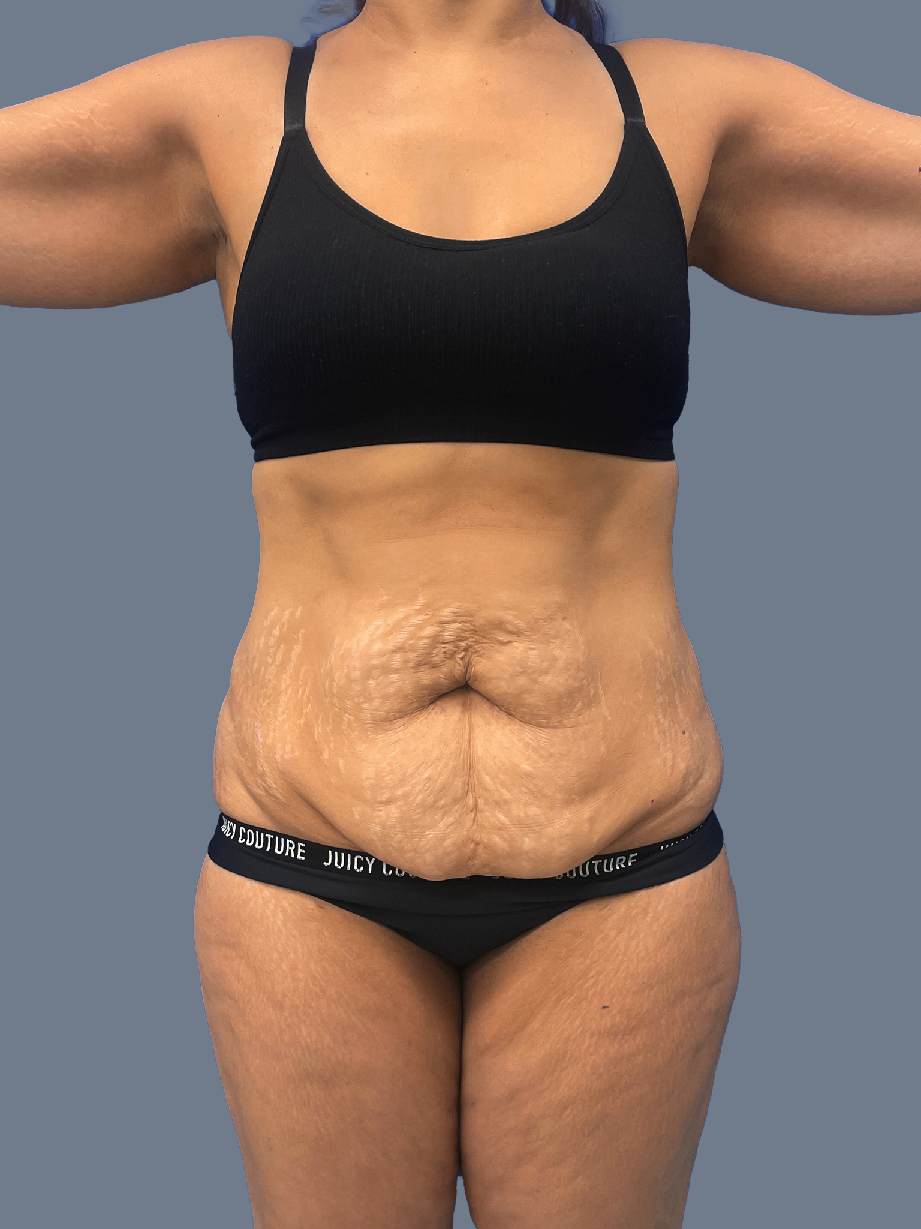 Case--3156-Lipo-360---8211--Tummy-Tuck | Before Lipo 360 - Tummy Tuck