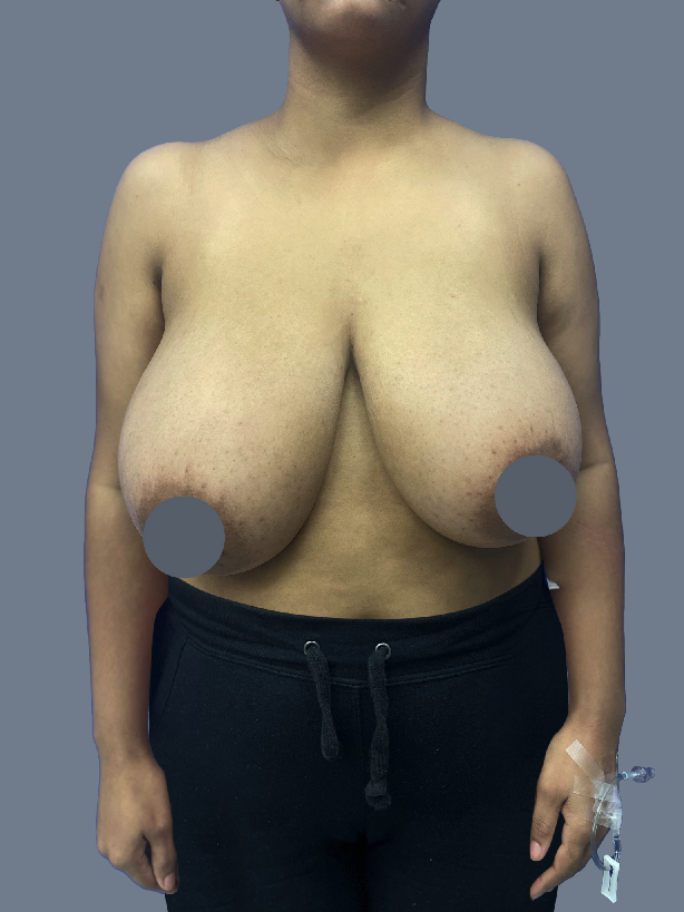 Case--5571-Breast-Lift-with-Reduction | Before Breast